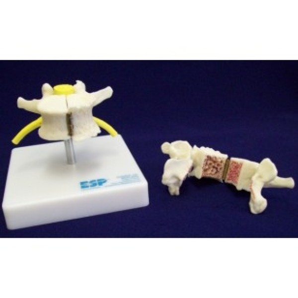 ESP Model Vertebra Showing Arthritis and Osteoporosis (ZJZ-240-A)