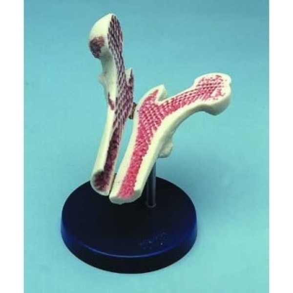 ESP Model Femur Head with Osteoporosis (ZJY-945-F)