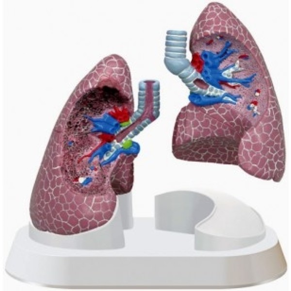 ESP Model Lung Pathologies (ZKJ-655-P)