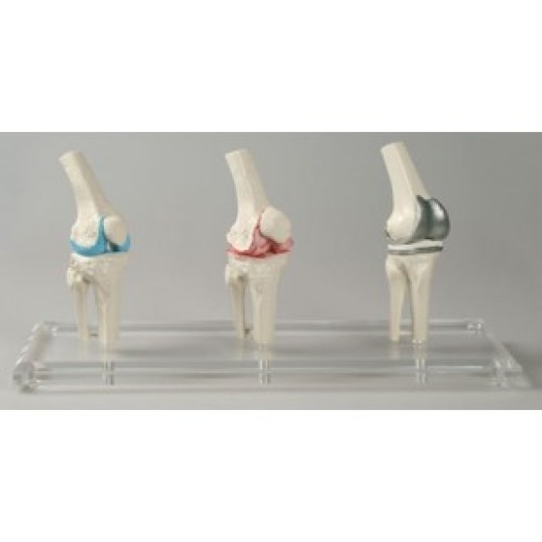 ESP Model Knee Implant, Set of 3 Joints (ZJY-887-K)