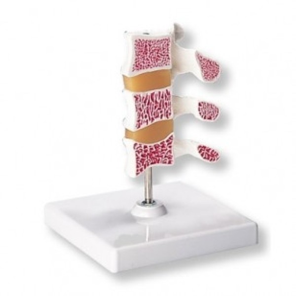 ESP Model Osteoporosis Model (3 Vertebrae) (ZJZ-540-K)