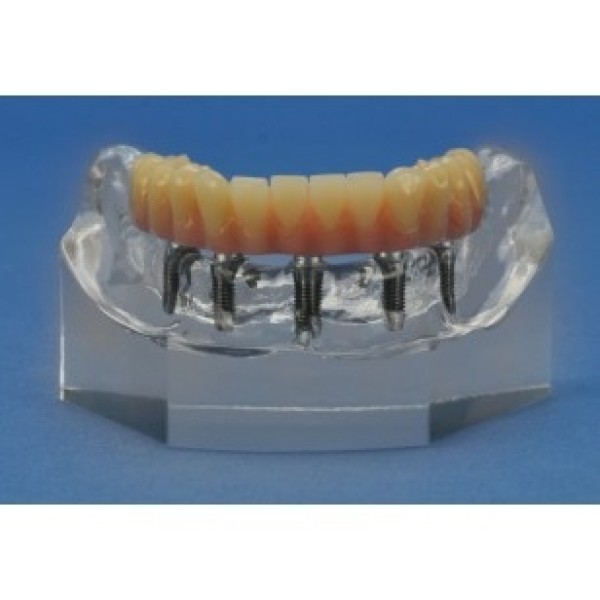 ESP Model Mini-Implant Mandible (ZDM-019-MI)