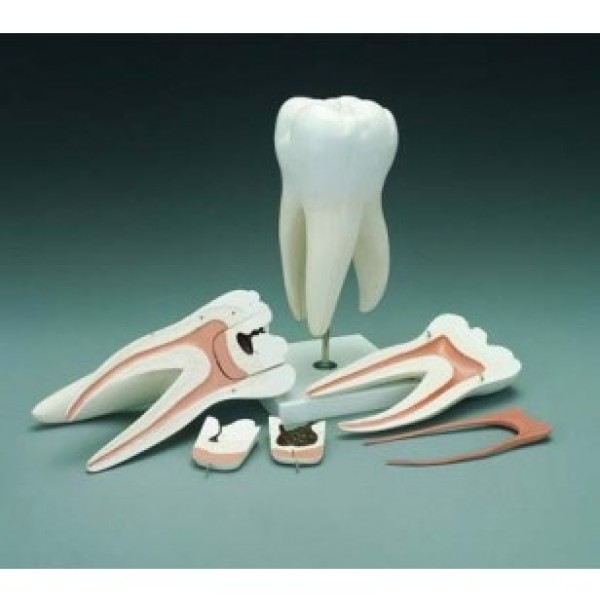 ESP Model Tooth Decay (ZKH-817-R)