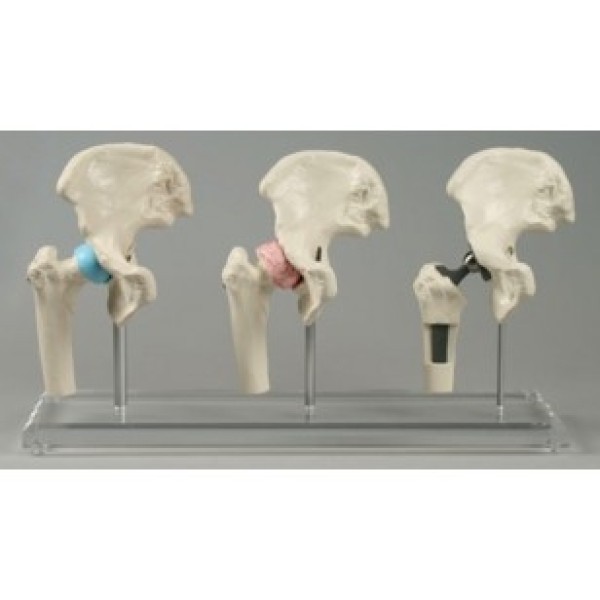 ESP Model Hip Implant Model Set of 3 Joints (ZJY-826-H)