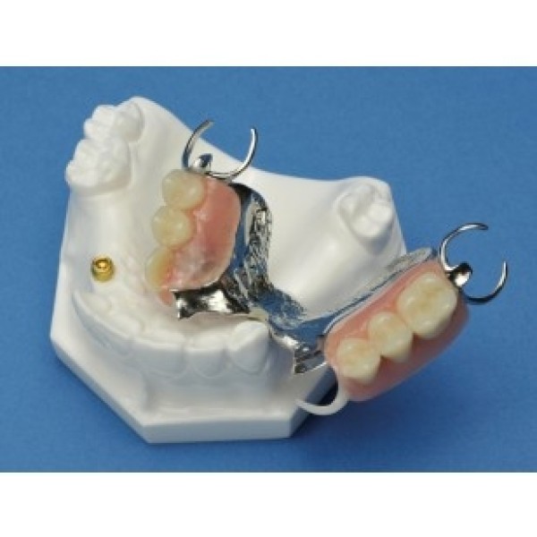 ESP Model Partial Framework Maxilla with Locator Stud & Cap (ZDM-013-PF)