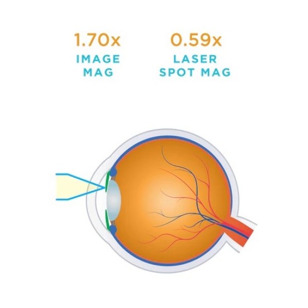 Volk Iridectomy Lens (2105-L-1605)